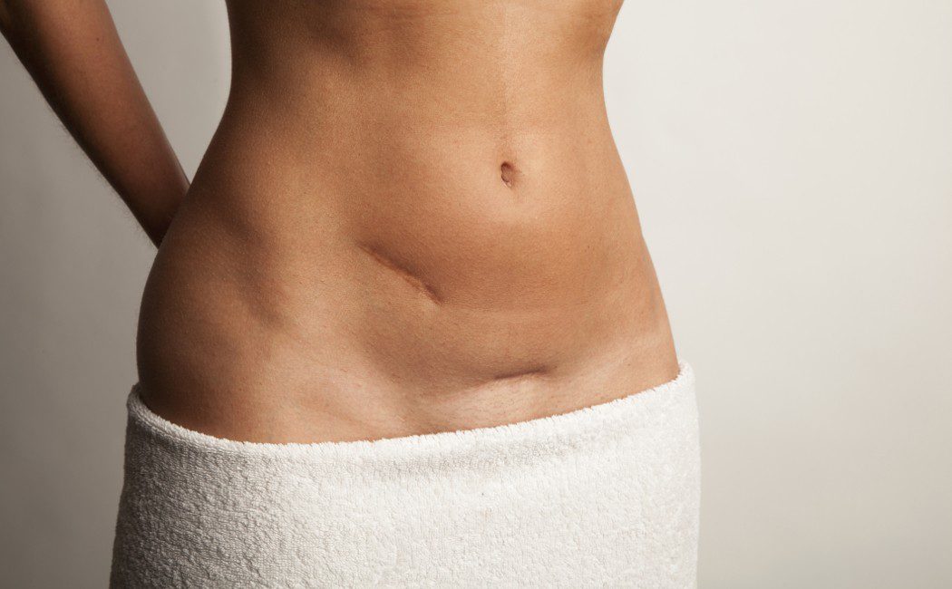 TENGO UNA HERNIA EN LA INGLE, AFECTA LA ERECCIÓN?