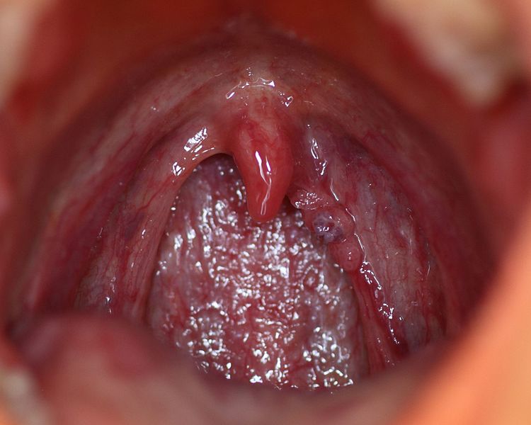 Me diagnosticaron el papiloma. ¿Eso significa que voy a tener cáncer?