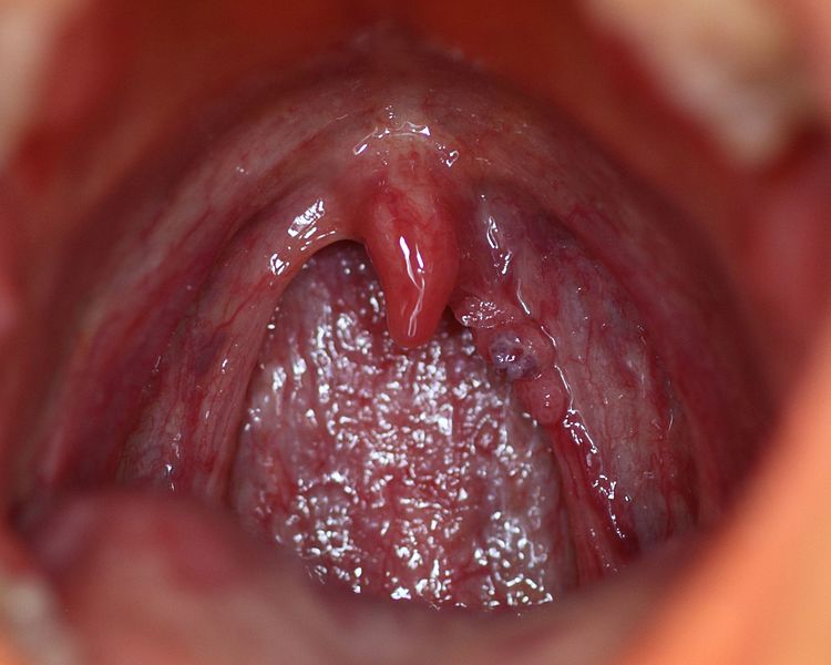 Me diagnosticaron el papiloma. ¿Eso significa que voy a tener cáncer?