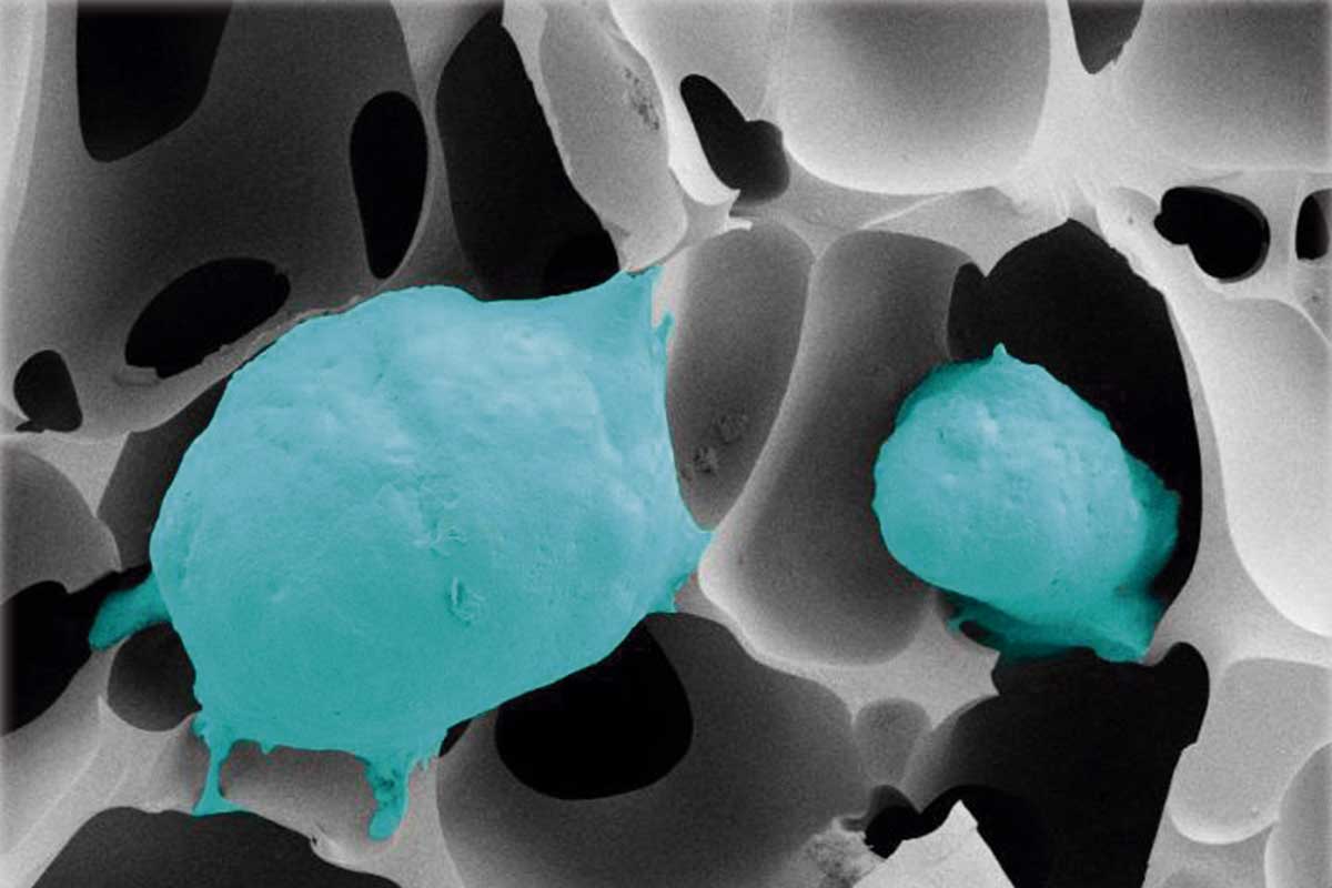 CÁNCER DE PRÓSTATA