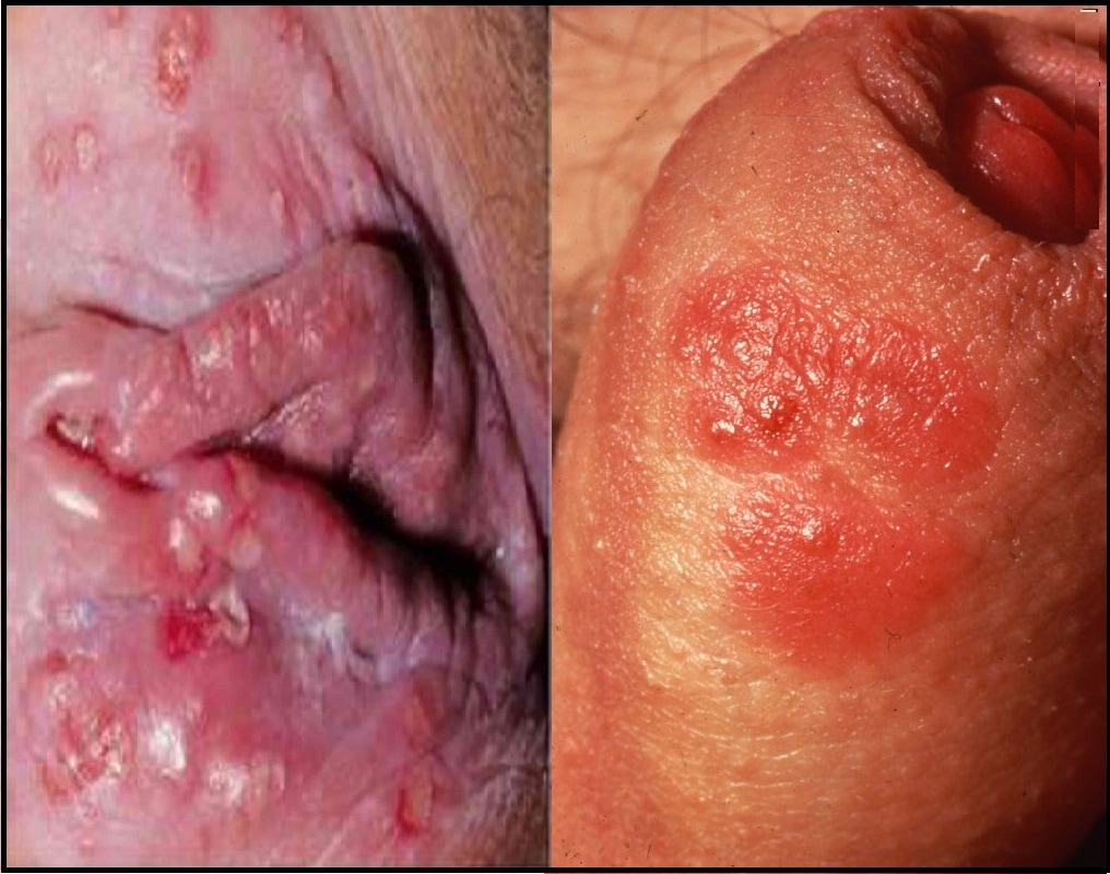 Fotos de herpes genital feminino