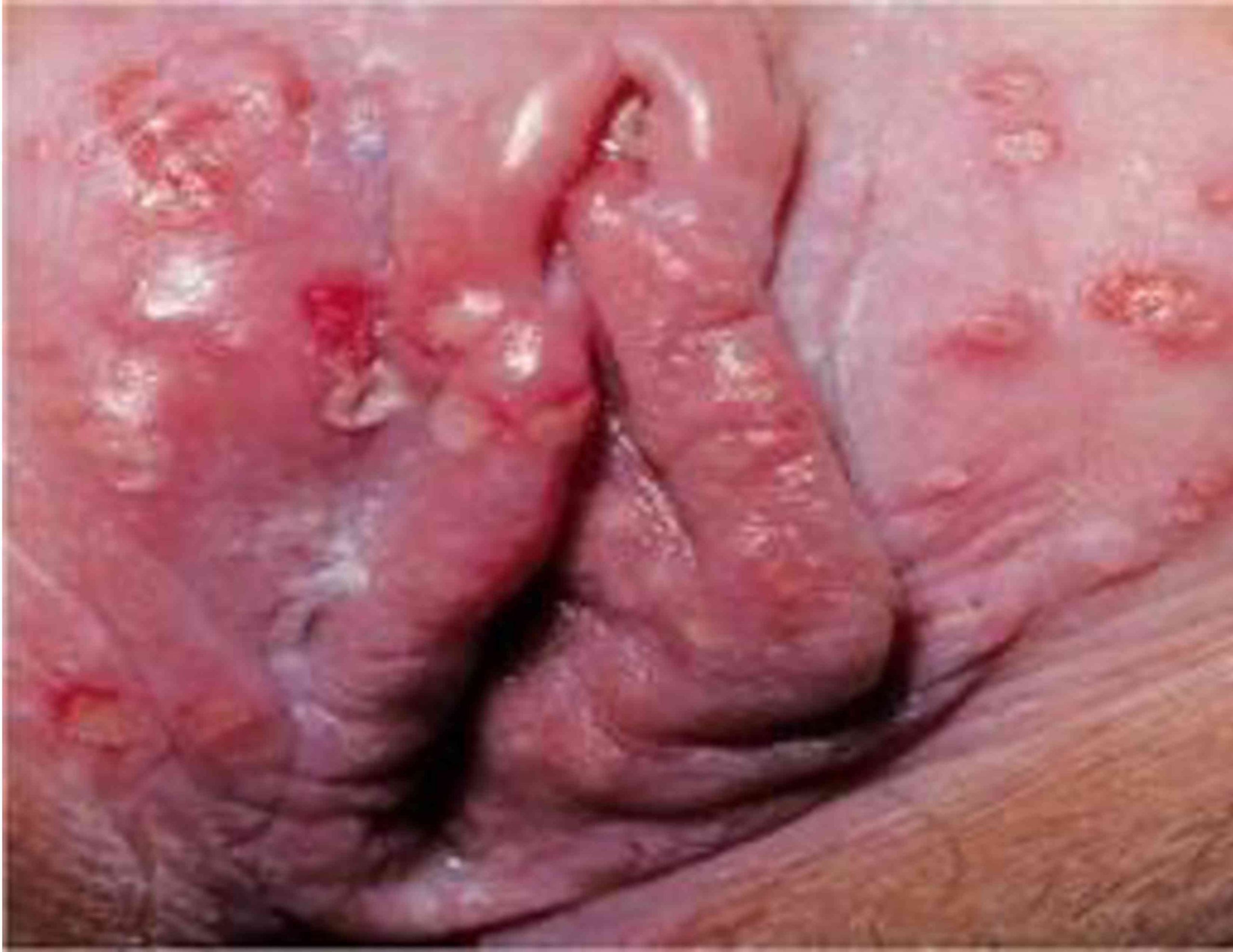 HERPES GENITAL